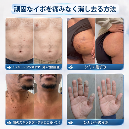 HISKIN® 👩‍⚕️ 7日間 スキンタグ＆スポットケアイレーサー 痛みを抑え、肌への負担に配慮した次世代ローラーボール式集中ケア