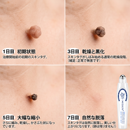 HISKIN® 👩‍⚕️ 7日間 スキンタグ＆スポットケアイレーサー 痛みを抑え、肌への負担に配慮した次世代ローラーボール式集中ケア
