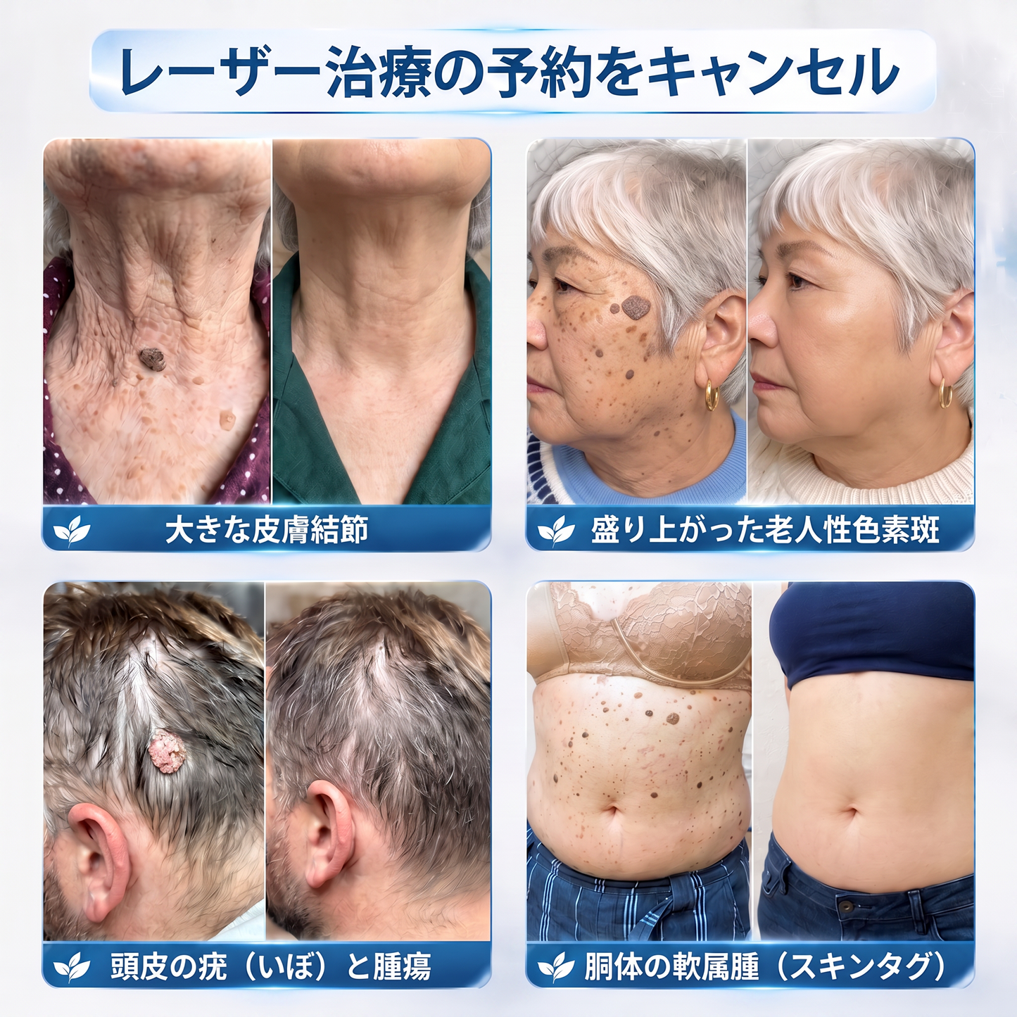 HISKIN® 👩‍⚕️ 7日間 スキンタグ＆スポットケアイレーサー 痛みを抑え、肌への負担に配慮した次世代ローラーボール式集中ケア