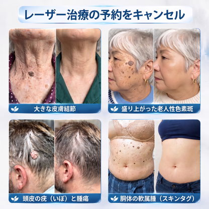 HISKIN® 👩‍⚕️ 7日間 スキンタグ＆スポットケアイレーサー 痛みを抑え、肌への負担に配慮した次世代ローラーボール式集中ケア